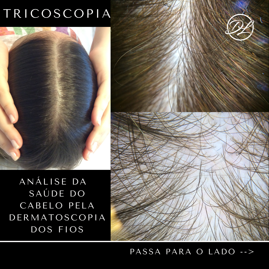 Tricoscopia, análise da saúde do seu cabelo