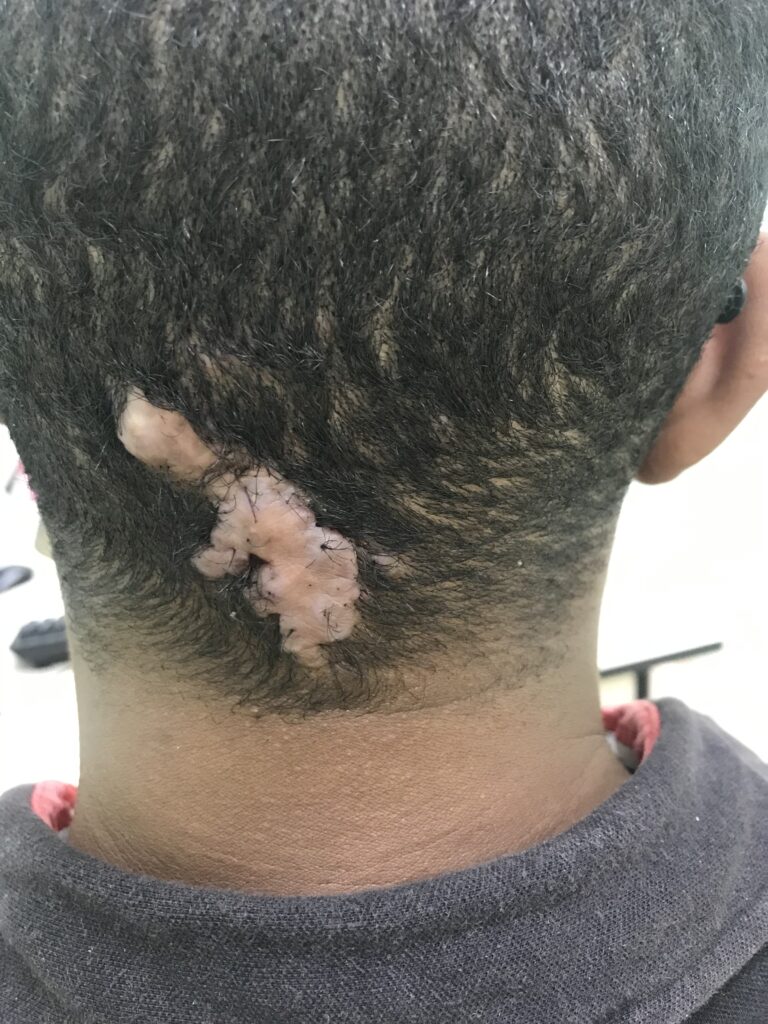 Foliculite Queloidiana da Nuca: Tratamento Dermatológico