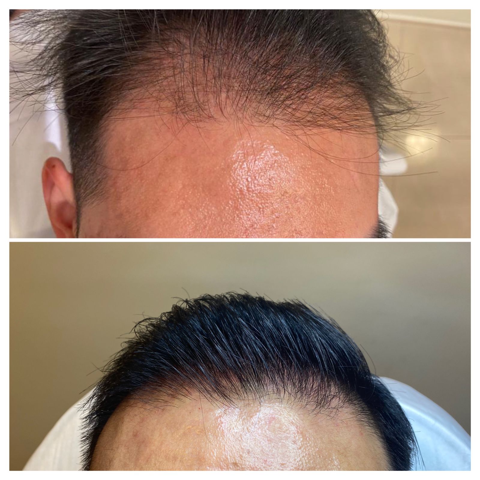Alopecia, androgenética, queda de cabelo, calvicie