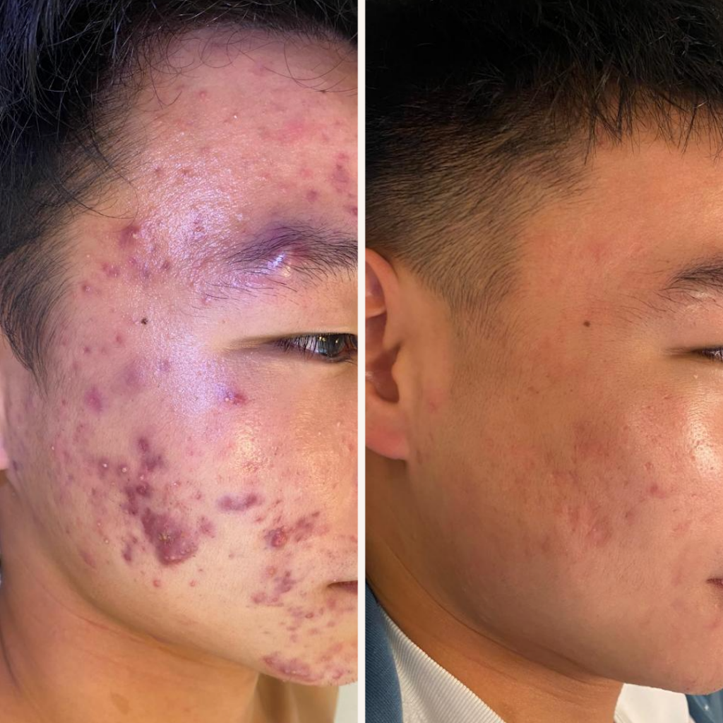 antes e depois tratamento de espinha acne